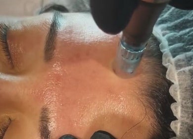 Microneedling at Perfect Beauty Setubal in Setúbal, Setúbal, PT enhances skin texture and glow.