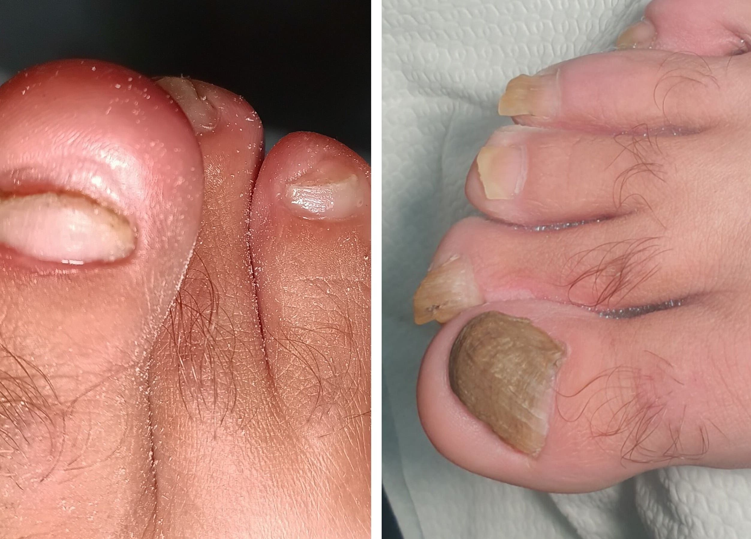 Снимка на проблемни нокти на крака, заснети в Algara beauty studio, Шумен, Област Шумен, BG.