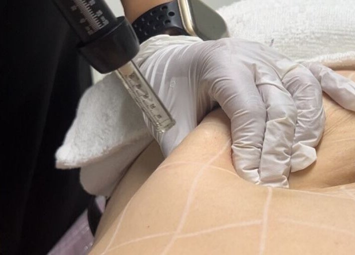 Procedimento estético no Essence Body, Algueirão-Mem Martins, Lisboa, PT. Detalhe de tratamento corporal.