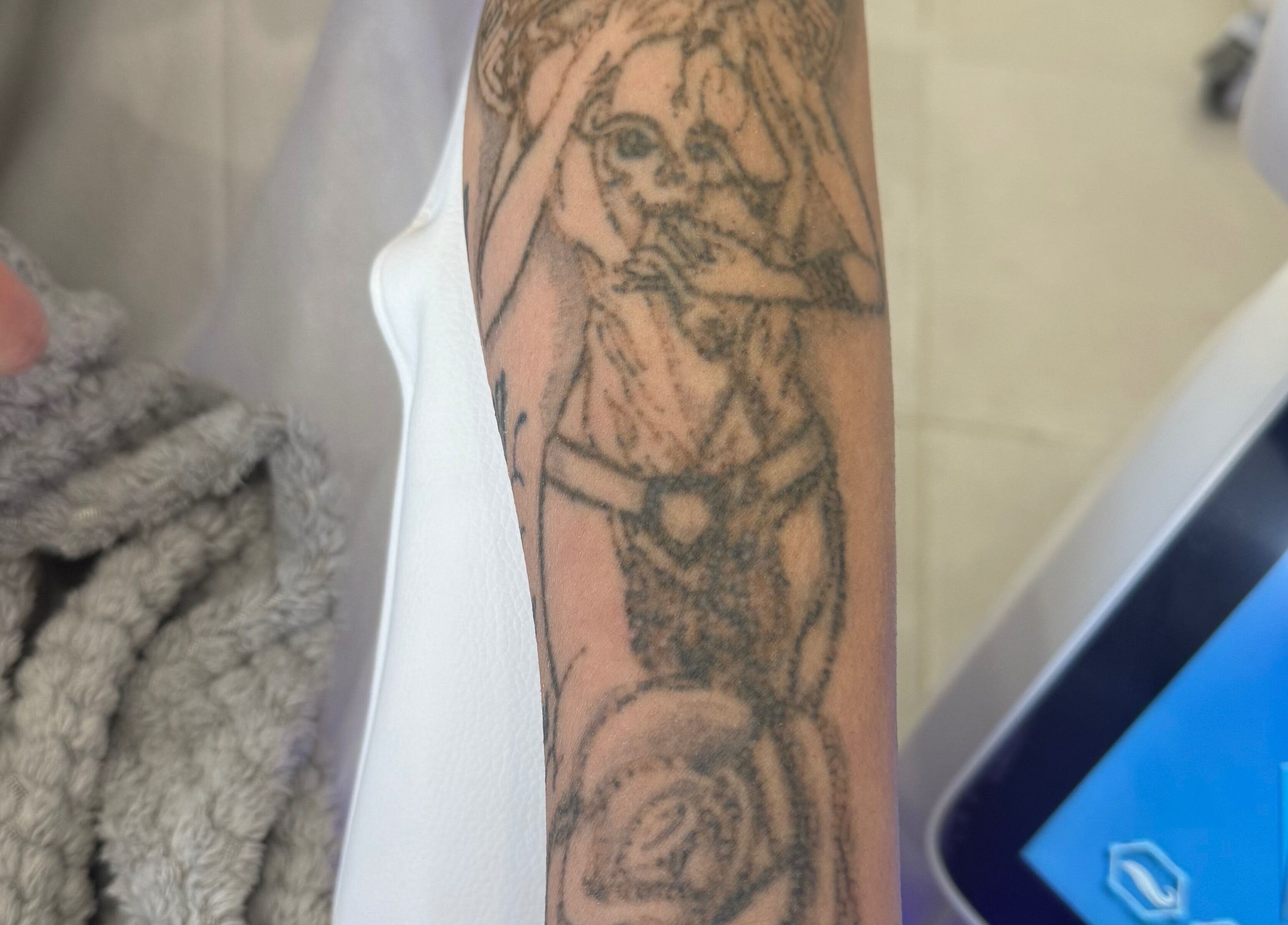 Arm tattoo removal in progress at Studio Skinthetics, Kalkallo, Victoria, AU with advanced laser technology.