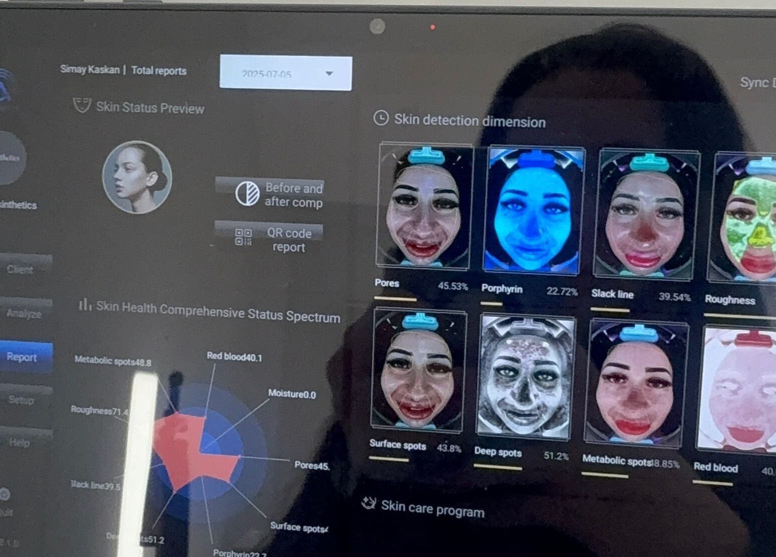 Facial analysis system at Studio Skinthetics, Kalkallo, Victoria, AU, showcasing diverse skin metrics.