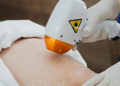 Tratamento a laser na pele no Minha Flor Nails & Spa em Lisboa, Lisboa, PT.