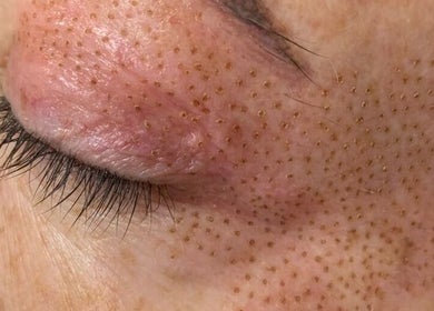 Close-up skin treatment at Oh Honey Beauty in Subiaco, Western Australia, AU, highlighting texture and care.