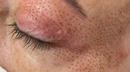 Close-up skin treatment at Oh Honey Beauty in Subiaco, Western Australia, AU, highlighting texture and care.