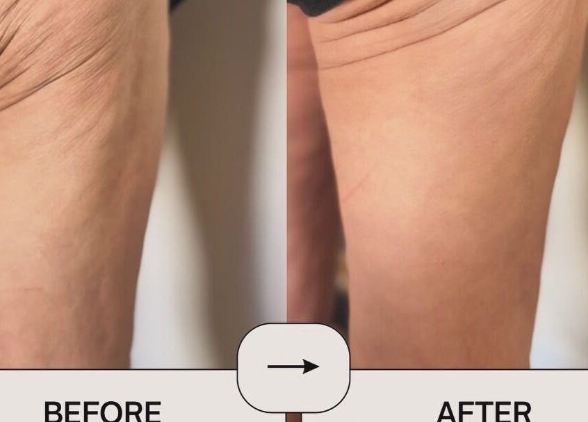 Before and after leg skin treatment at Oh Honey Beauty, Subiaco, Western Australia, AU.