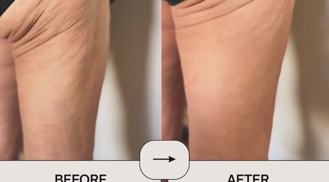 Before and after leg skin treatment at Oh Honey Beauty, Subiaco, Western Australia, AU.