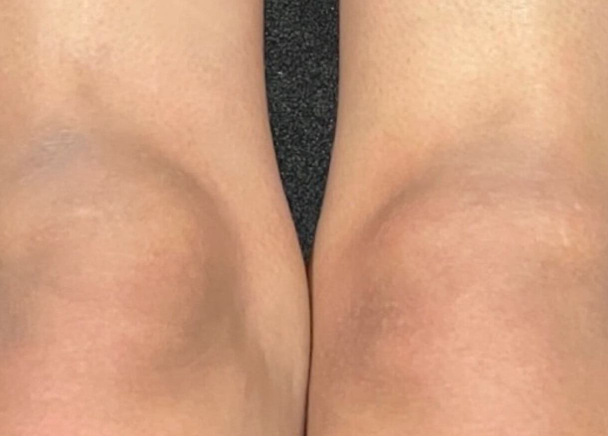 Close-up of smooth knees at All About You BodySculpting Perth, Mount Pleasant, Western Australia, AU.