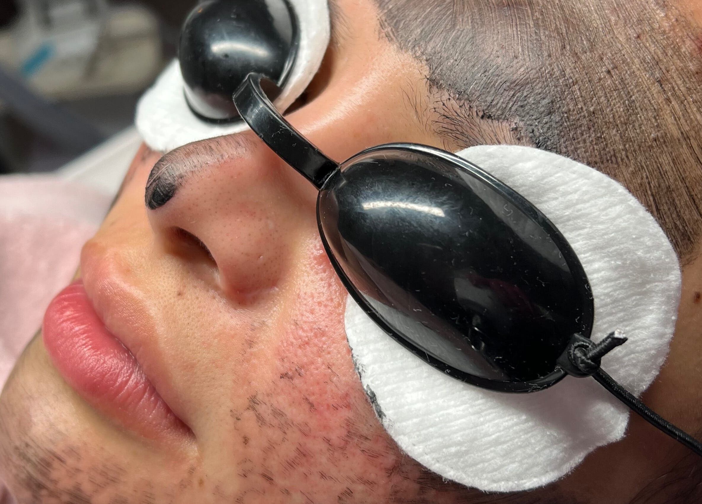 Facial laser treatment at All About You BodySculpting Perth, Mount Pleasant, Western Australia, AU.