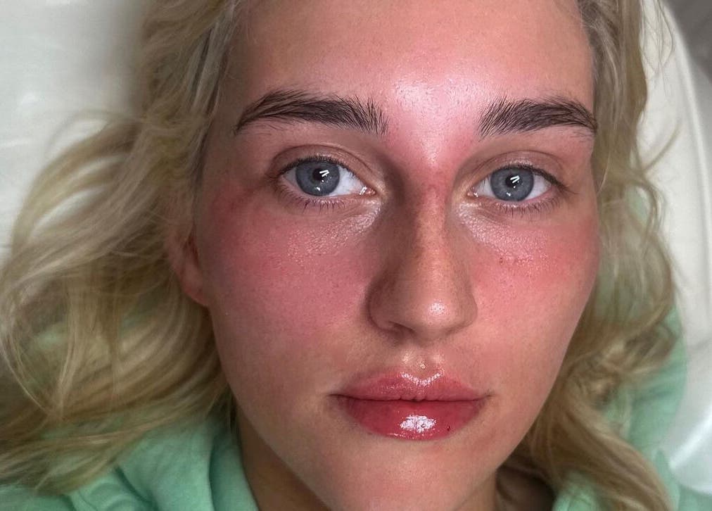 Radiant complexion after facial at Sculpt Aesthetics, Sunderland, England, GB. Fresh and rejuvenated skin.