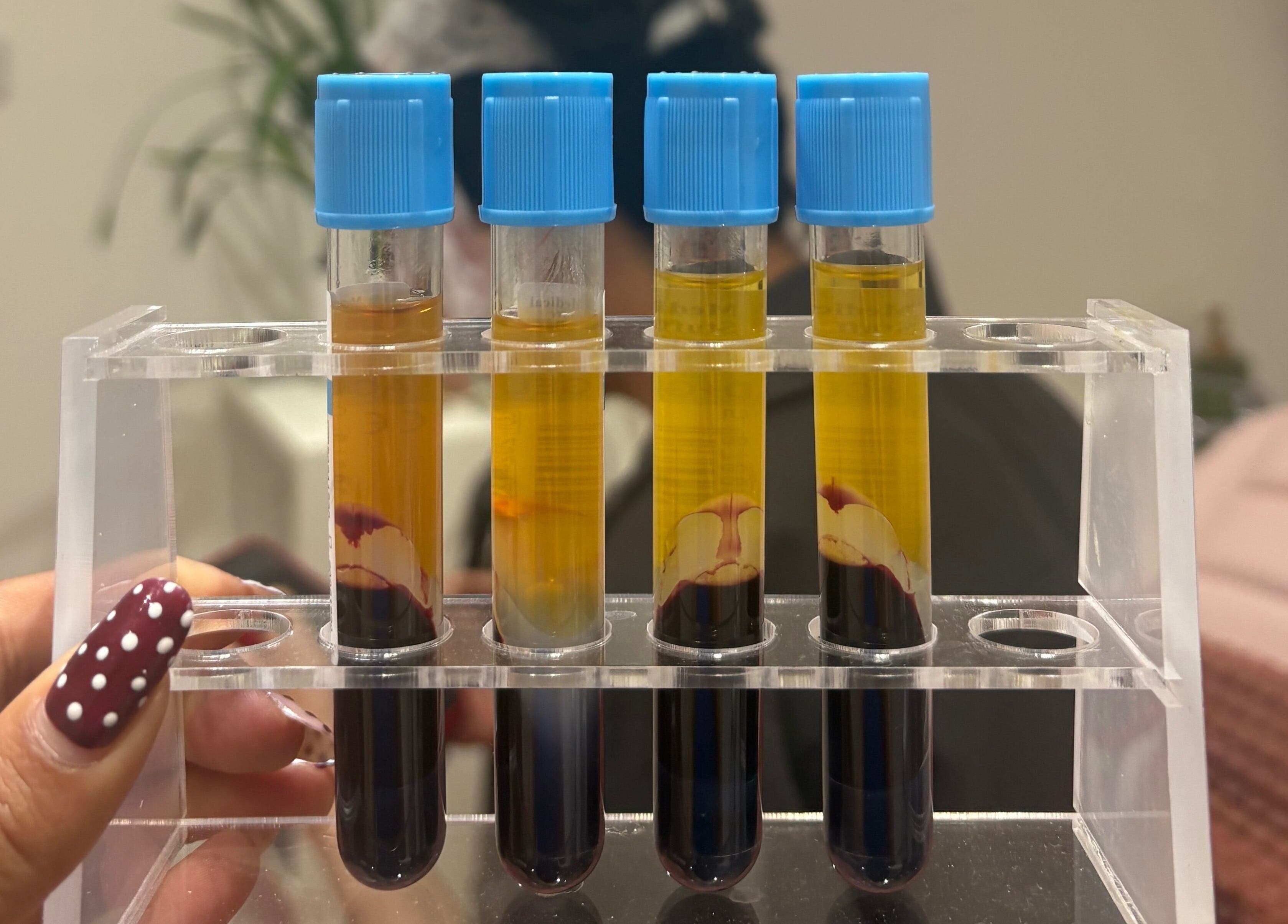 Blood samples in test tubes for treatment at Ethereal Aesthetics, London, England, GB.