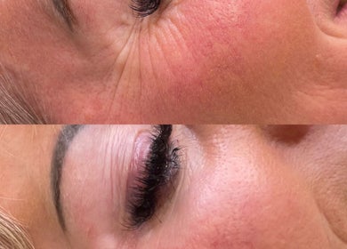Close-up of facial skin before and after treatment at SILCRESS, Old Windsor, England, GB.