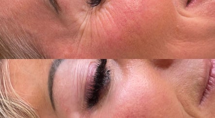 Close-up of facial skin before and after treatment at SILCRESS, Old Windsor, England, GB.