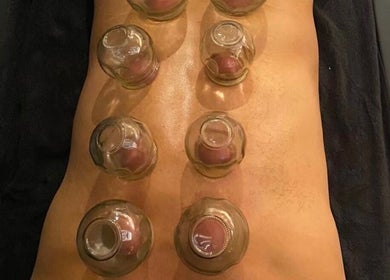 Experience cupping therapy at A.J.Healing, South Ockendon, England, GB for rejuvenation and wellness.