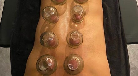 Cupping therapy on a back at A.J.Healing, South Ockendon, England, GB.