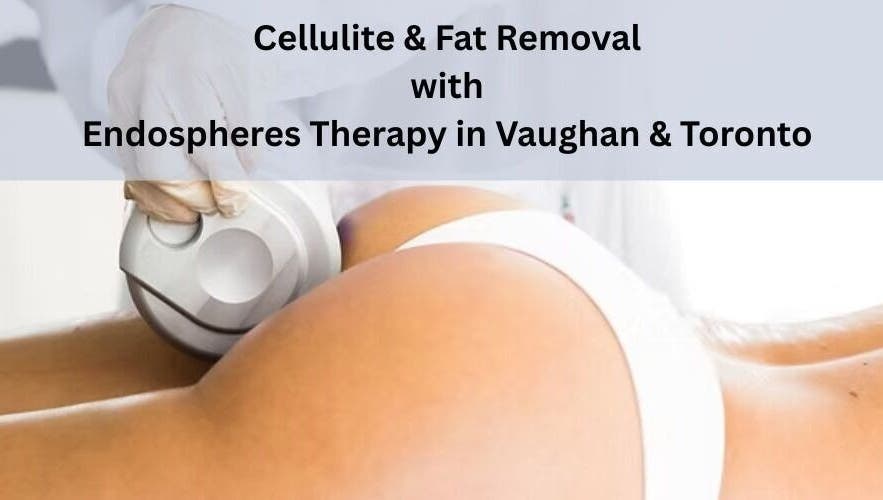 Endospheres therapy at MK Cosmetic Clinic, Vaughan, Ontario, CA for cellulite and fat removal.