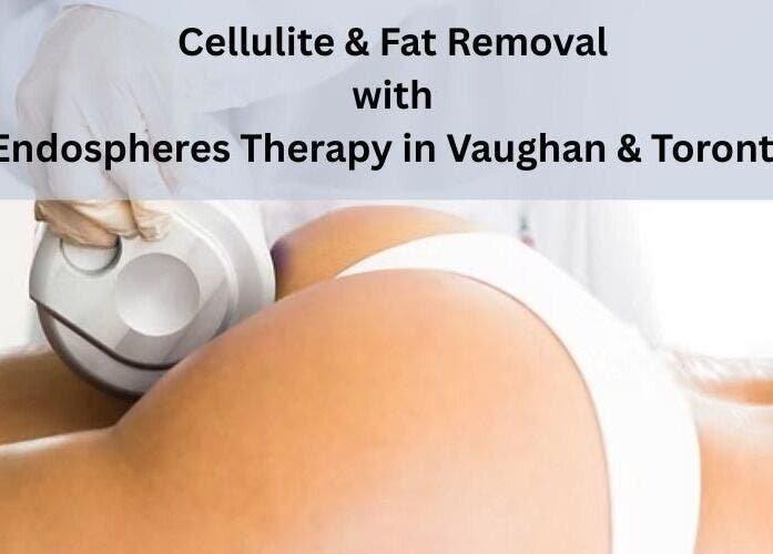 Endospheres therapy at MK Cosmetic Clinic, Vaughan, Ontario, CA for cellulite and fat removal.