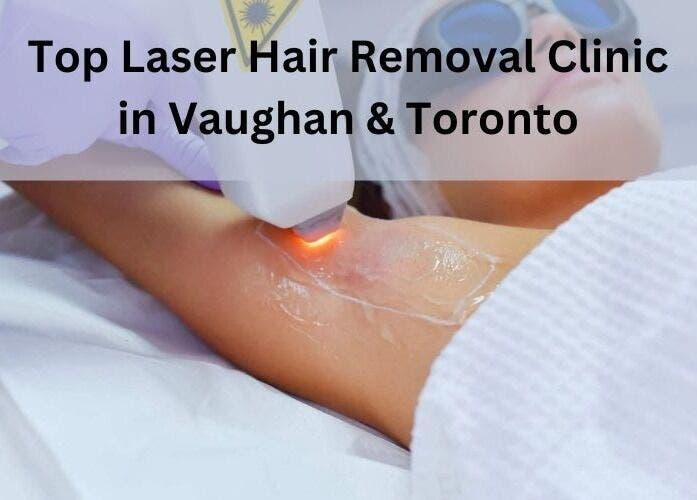 Laser hair removal session at MK Cosmetic Clinic in Vaughan, Ontario, CA.