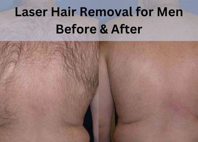 Before and after laser hair removal for men at MK Cosmetic Clinic, Vaughan, Ontario, CA.