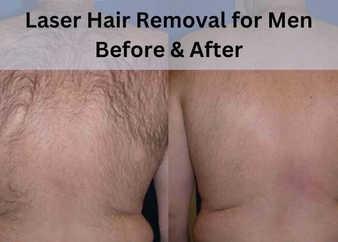 Before and after laser hair removal for men at MK Cosmetic Clinic, Vaughan, Ontario, CA.