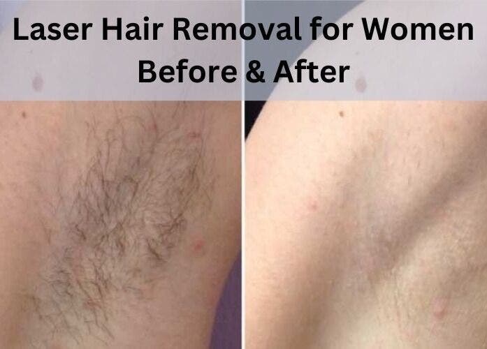 Before and after laser hair removal at MK Cosmetic Clinic, Vaughan, Ontario, CA, showcasing smooth skin results.