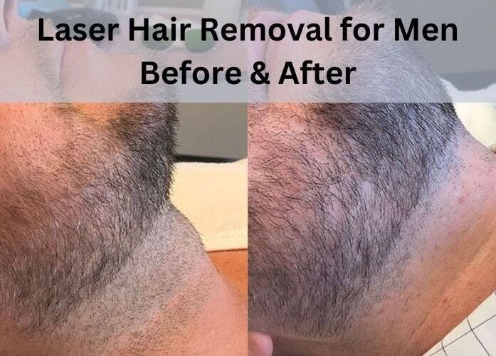 MK Cosmetic Clinic in Vaughan, Ontario, CA: laser hair removal for men - before and after comparison.
