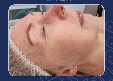 Facial treatment at Kristys Beauty Whitby, showcasing rejuvenation techniques in Whitby, England, GB.