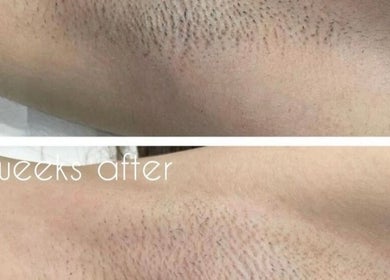 Comparison of underarm skin before and after treatment at Za Za Beauty, Winchester, England, GB
