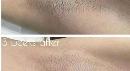 Comparison of underarm skin before and after treatment at Za Za Beauty, Winchester, England, GB