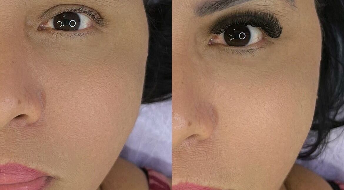 Antes e depois dos cílios na Elohim Clinic, São Paulo, BR, destacando transformação notável.