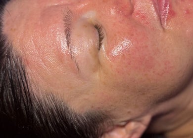 Close-up of a freshly treated face at The Lash Room, Ayr, Scotland, GB, showcasing smooth, glowing skin.