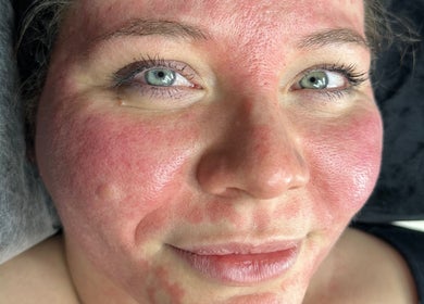 Close-up of a woman's face post-facial treatment at PAŁKA | Witney Beauty & Aesthetics, Witney, England, GB.