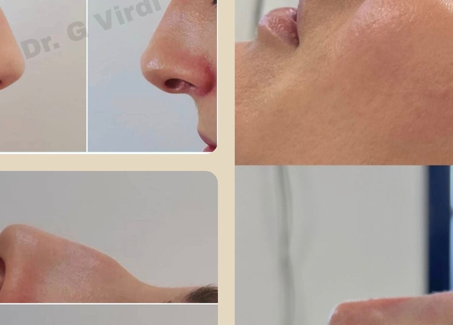 Profile views of nose treatments at Aesthetics by Lyssa, Rhyl, Wales, GB. Highlighting contour transformations.