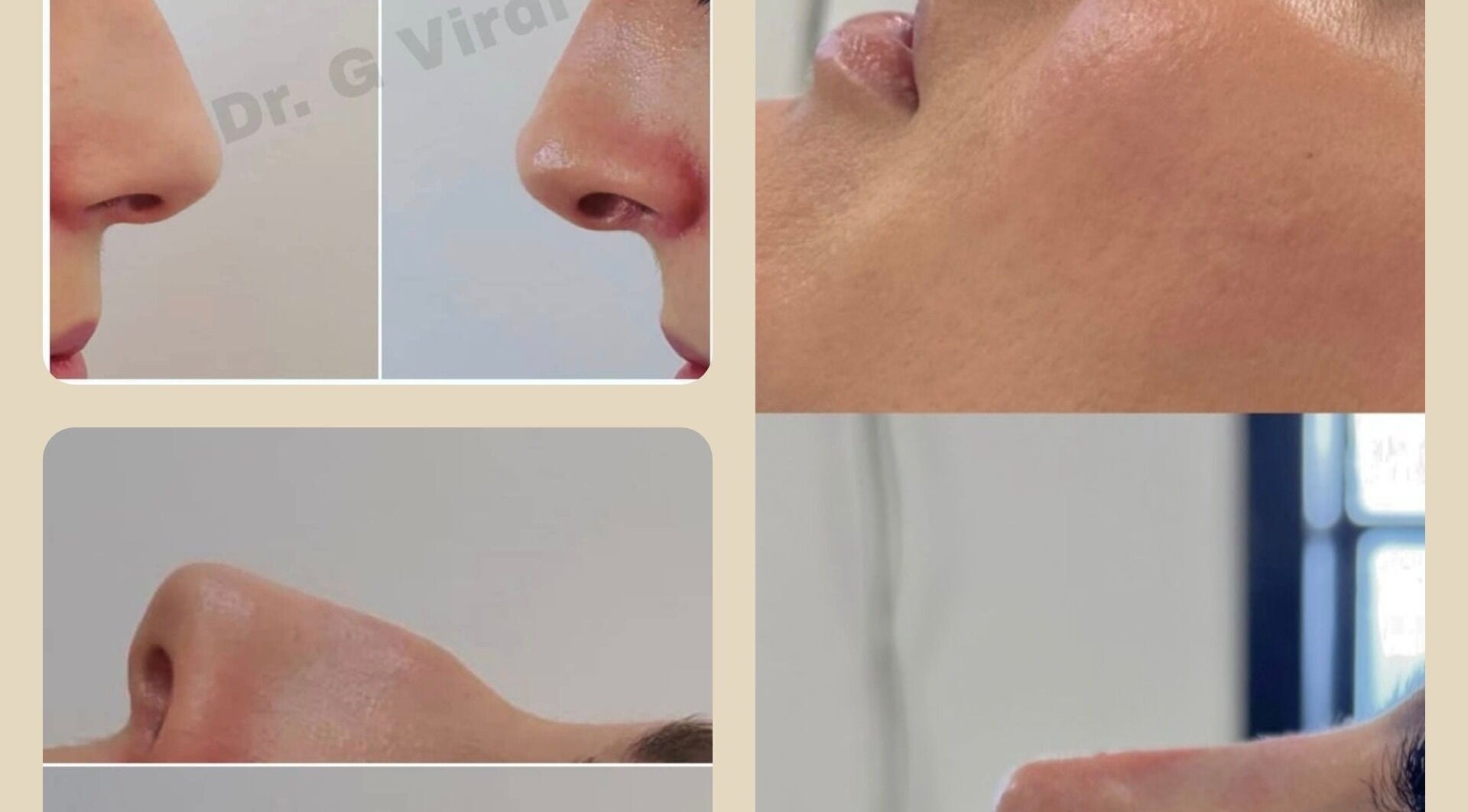 Profile views of nose treatments at Aesthetics by Lyssa, Rhyl, Wales, GB. Highlighting contour transformations.