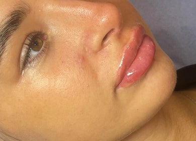 Close-up of radiant skin and enhanced lips at Lips&Lines, Dublin, County Dublin, IE.
