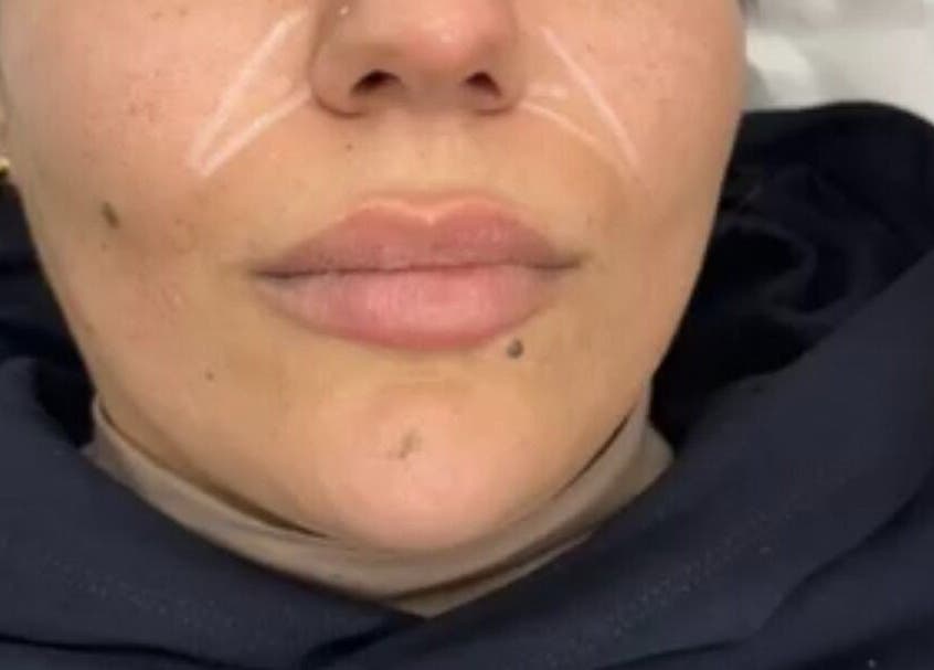Lip enhancement procedure at Glowtonix, Borehamwood, England, GB, showcasing precise technique on client.