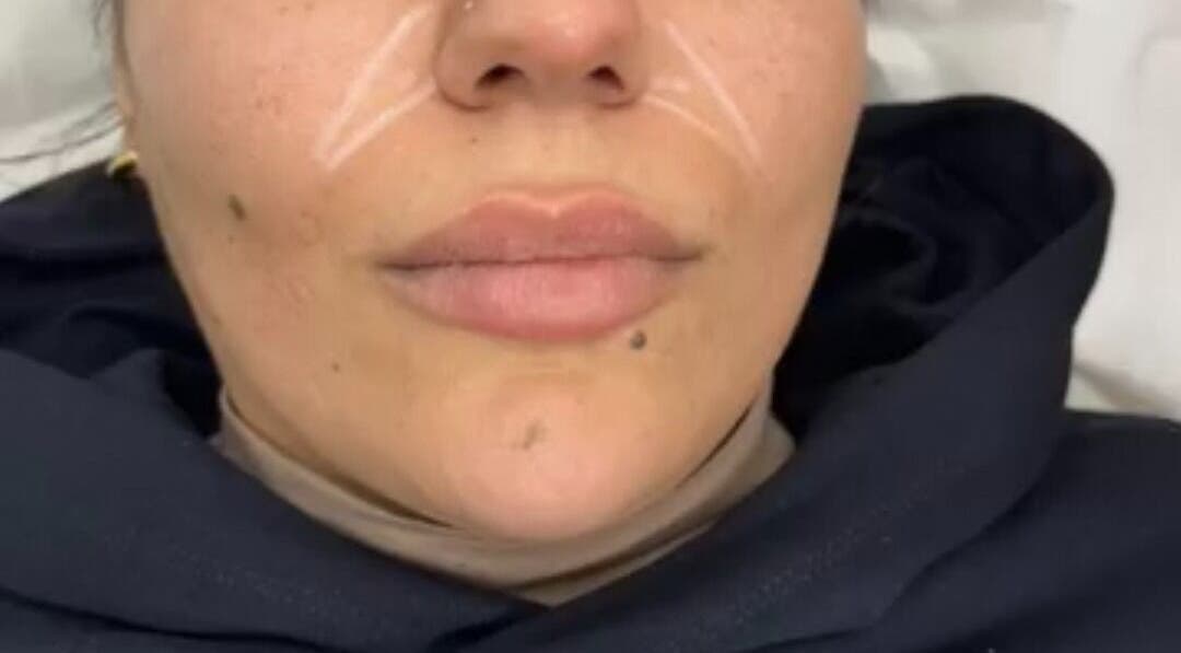Lip enhancement procedure at Glowtonix, Borehamwood, England, GB, showcasing precise technique on client.