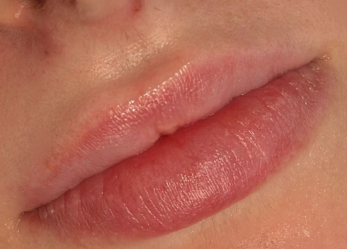 Close-up of lips showing enhancement at Julia Clark Aesthetics & Academy, Redbourn, England, GB.