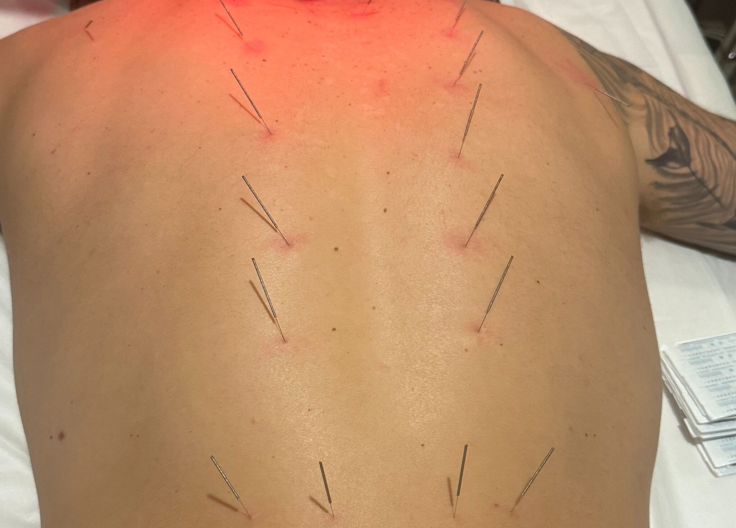 Acupuncture session at Zen Massage & Reflexology, Chatswood, New South Wales, AU. Needles on a person's back.