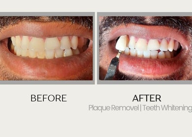 Before and after teeth whitening at Grin & Gloss Beauty Enhancements, Chaguanas, Chaguanas, TT.