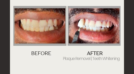 Before and after teeth whitening at Grin & Gloss Beauty Enhancements, Chaguanas, Chaguanas, TT.