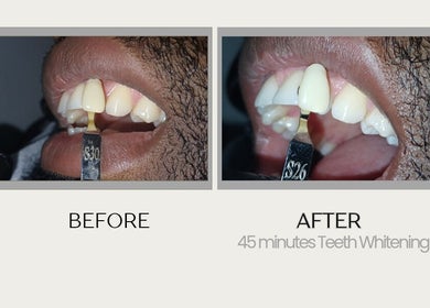 Before and after teeth whitening at Grin & Gloss Beauty Enhancements, Chaguanas, Chaguanas, TT.