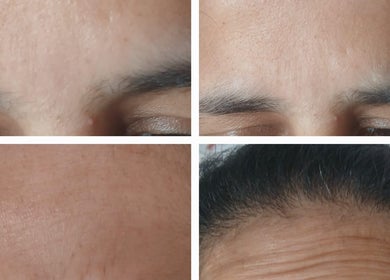 Before and after treatment results at Shine By S, showcasing revitalized foreheads in Peterborough, England, GB.