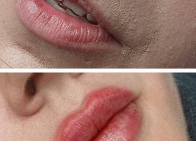 Before and after lip enhancement at Shine By S, Peterborough, England, GB shows fuller, vibrant lips.