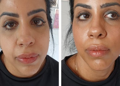 Close-up of radiant skin transformation at Shine By S, Peterborough, England, GB.