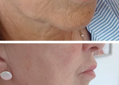 Before and after facial transformation at Shine By S, Peterborough, England, GB showing skin rejuvenation.