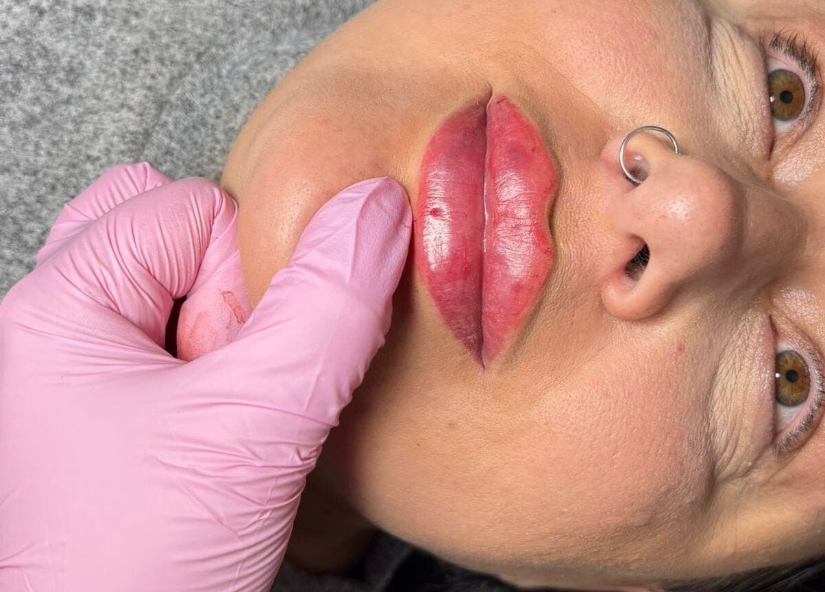 Lip enhancement treatment at Shine By S, Peterborough, England, GB. Aesthetic precision in beauty service.