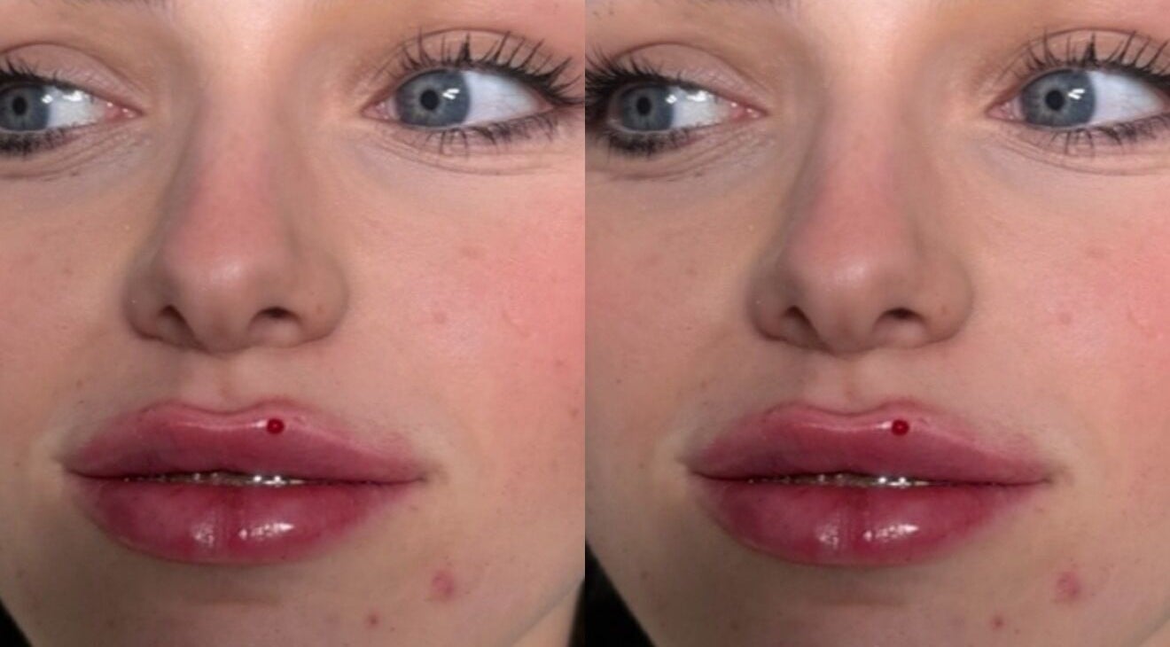 Close-up before-and-after lip enhancement at Aestheticsbysophia, Liverpool, England, GB.