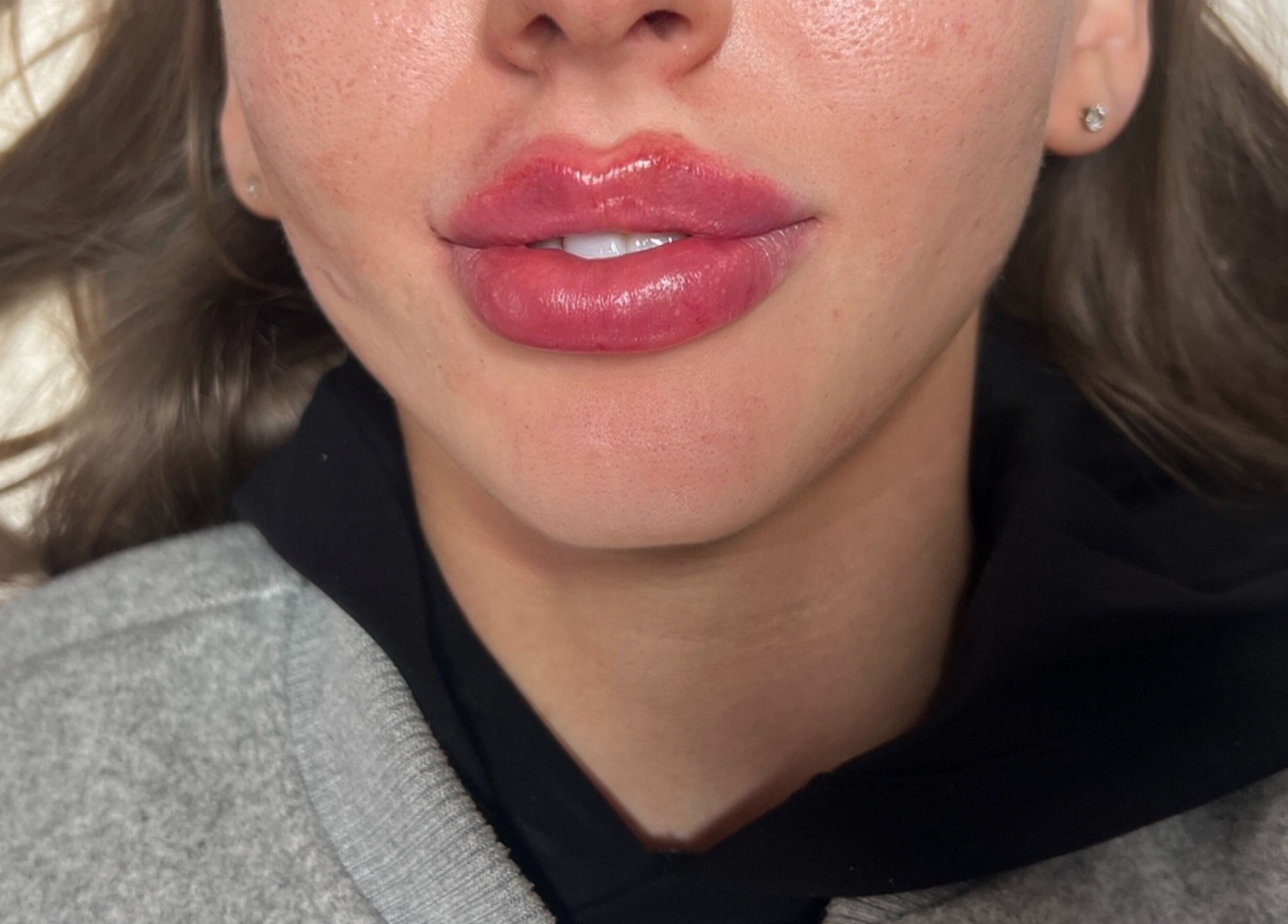 Close-up of glossy lips treatment at Aestheticsbysophia, Liverpool, England, GB.