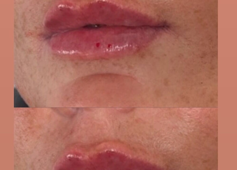 Lip enhancement at Aestheticsbysophia, Liverpool, England, GB, showcasing before and after results.