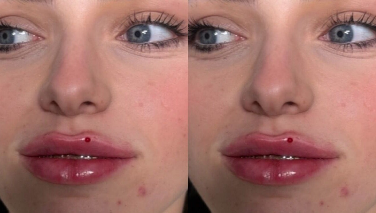 Close-up of lip enhancement results at Aestheticsbysophia, Liverpool, England, GB.